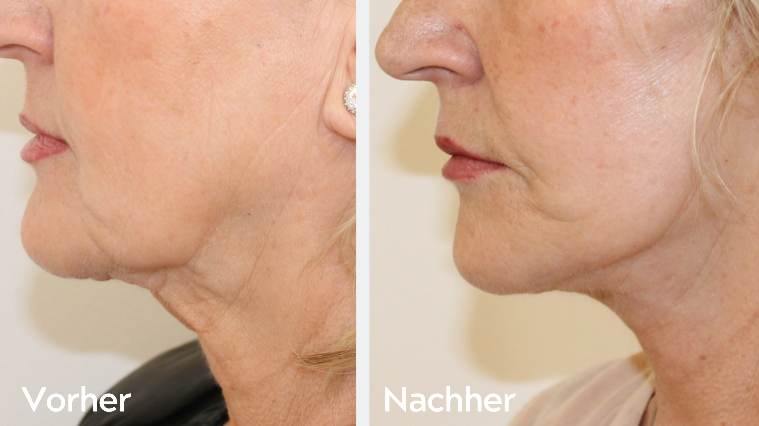 One-Stitch-Facelift – Ergebnis 1, Hals- und Kinnstraffung