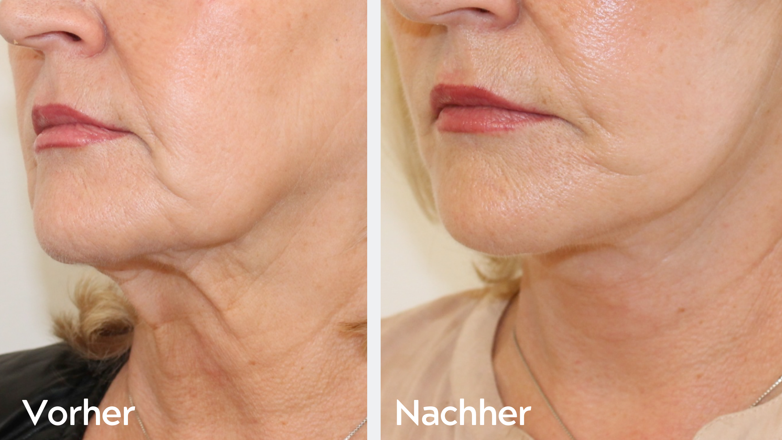 One-Stitch-Facelift – Ergebnis 2, Straffung Wangenpartie