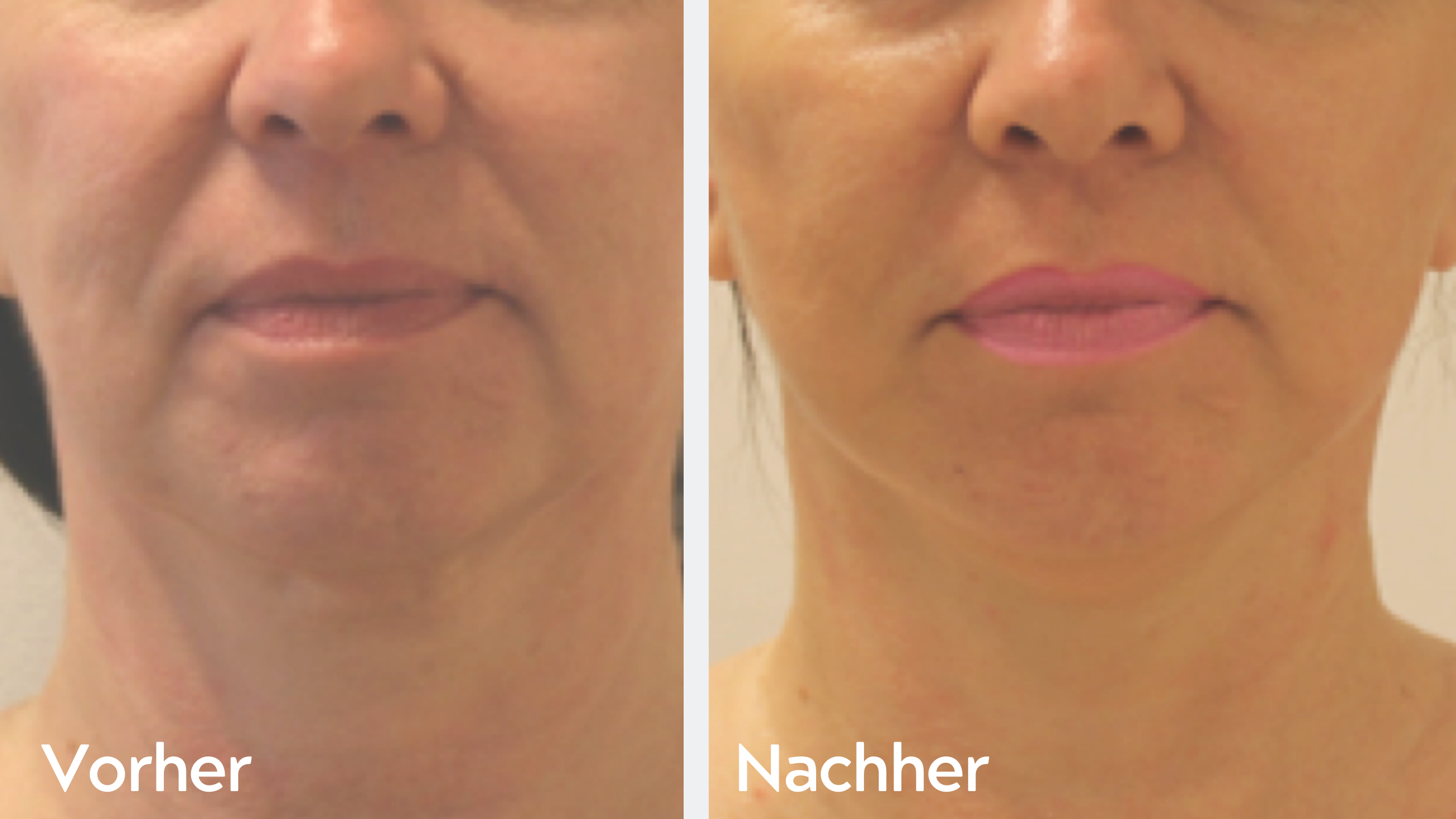One-Stitch-Facelift – Ergebnis 3, Kinn- und Halslinie