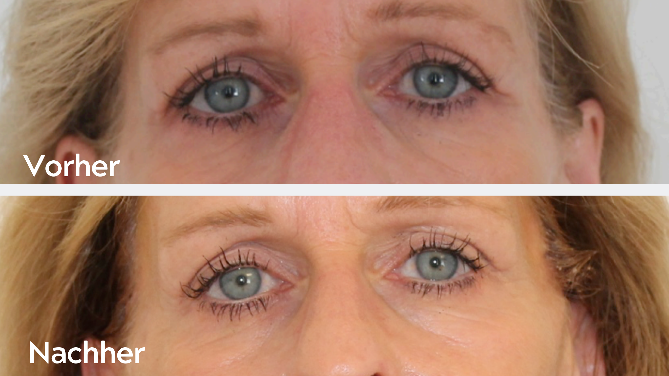 One-Stitch-Facelift – Ergebnis 4, Augenbrauenlifting