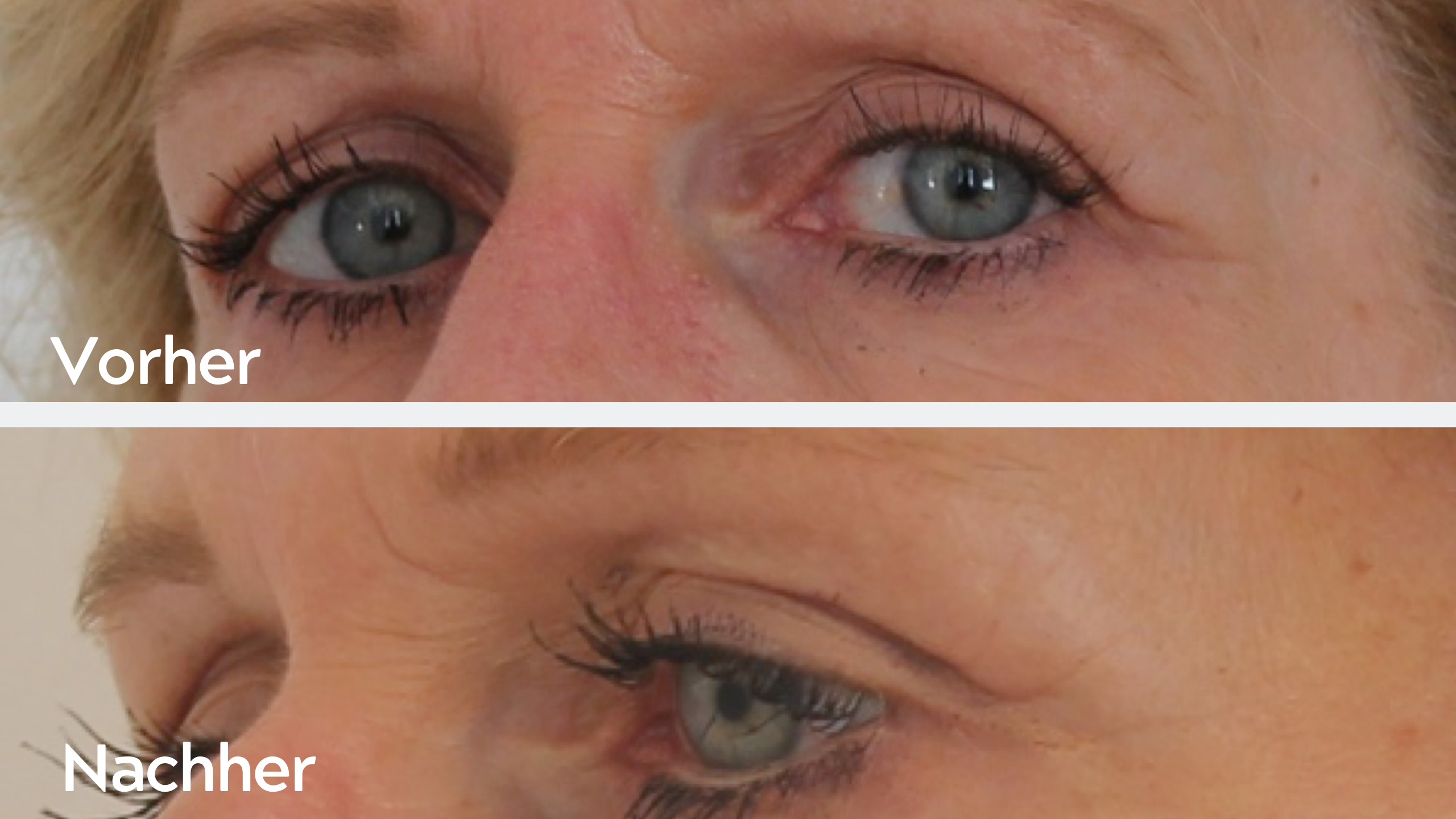 One-Stitch-Facelift – Ergebnis 5, Augenbereich