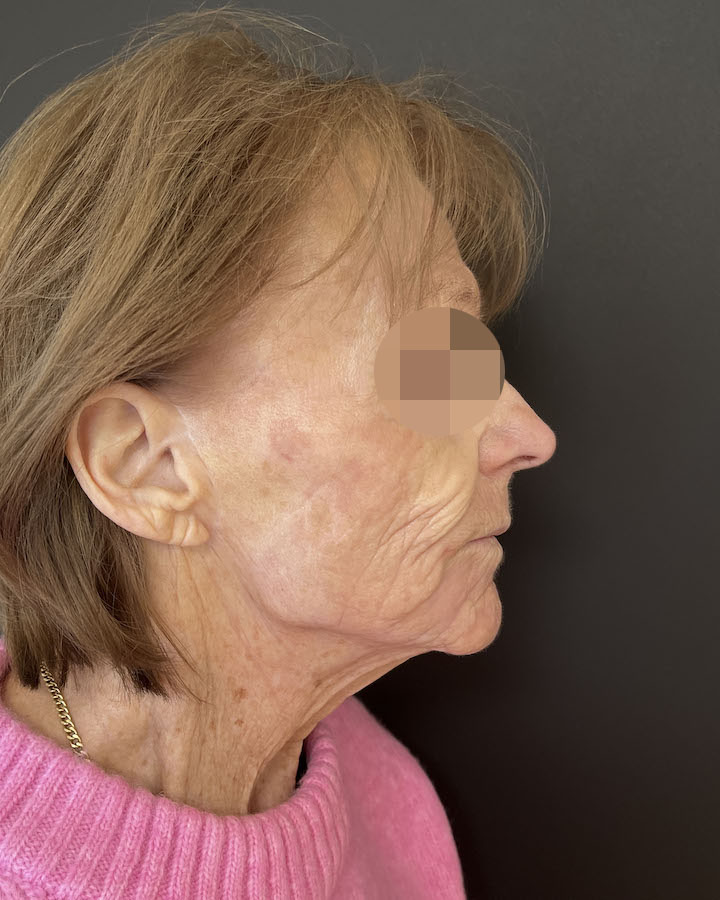 Phenol-Peeling Vorher-Nachher Vergleich 1 - Nachher
