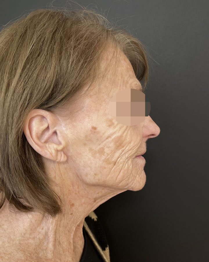 Phenol-Peeling Vorher-Nachher Vergleich 1 - Vorher